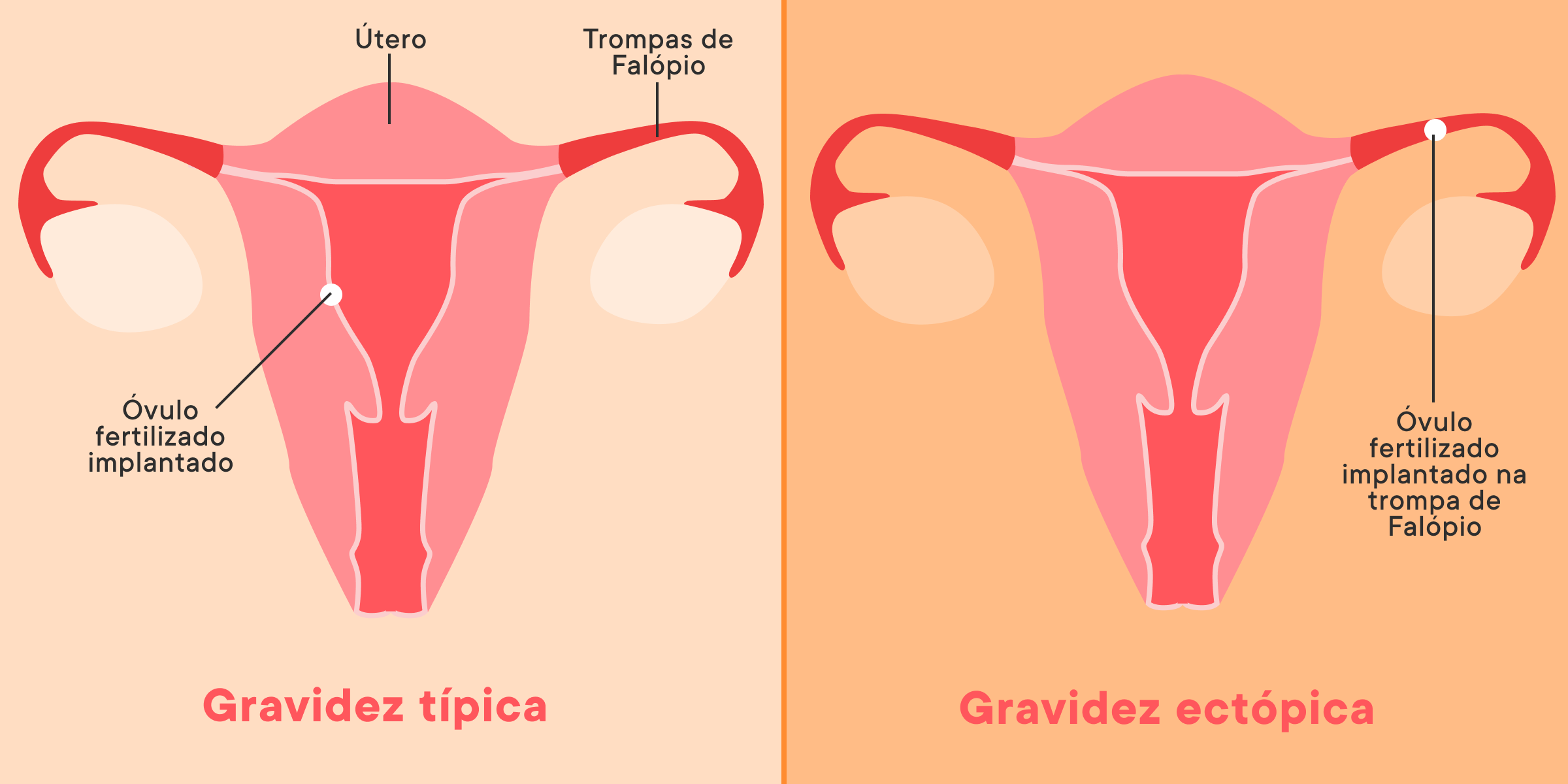 A Realidade das Doenças Inflamatórias Pélvicas (DIP) e Sua Conexão com Gravidez Ectópica - inspiração 2