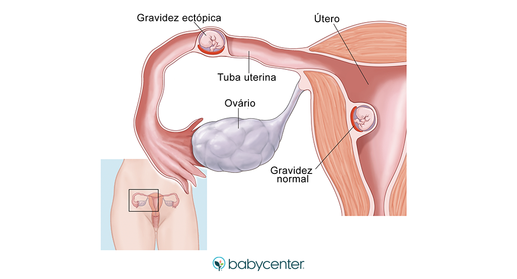 Cirurgias Abdominais Anteriores: Um Fator de Atenção para Sua Saúde - inspiração 2