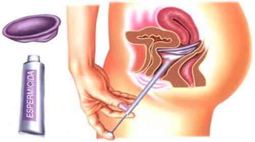 Aplicando o Espermicida: A Quantidade Ideal para uma Barreira Eficaz - inspiração 1