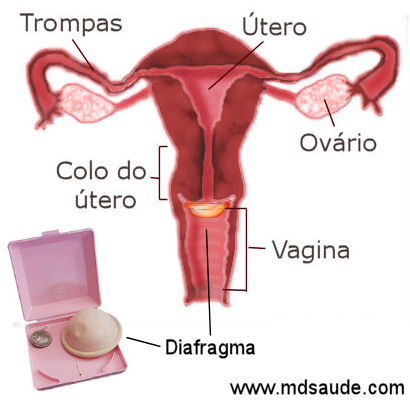 Como Inserir o Diafragma: Técnica e Posição Correta para Evitar Vazamentos - inspiração 2