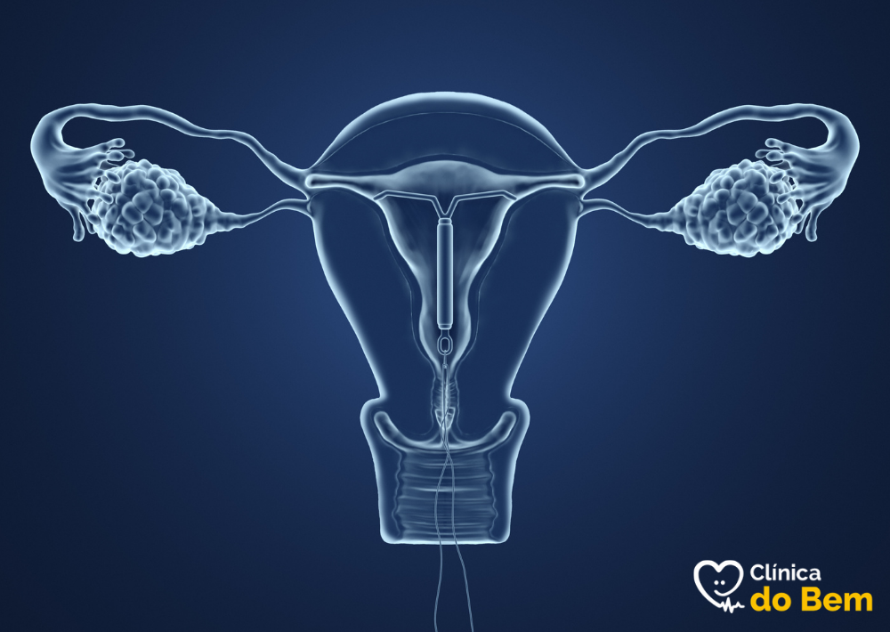 Tipos de DIU Hormonal Disponíveis no Brasil - inspiração 2