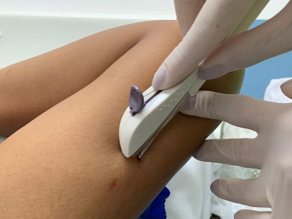 Como o Implante Contraceptivo Funciona? - inspiração 2