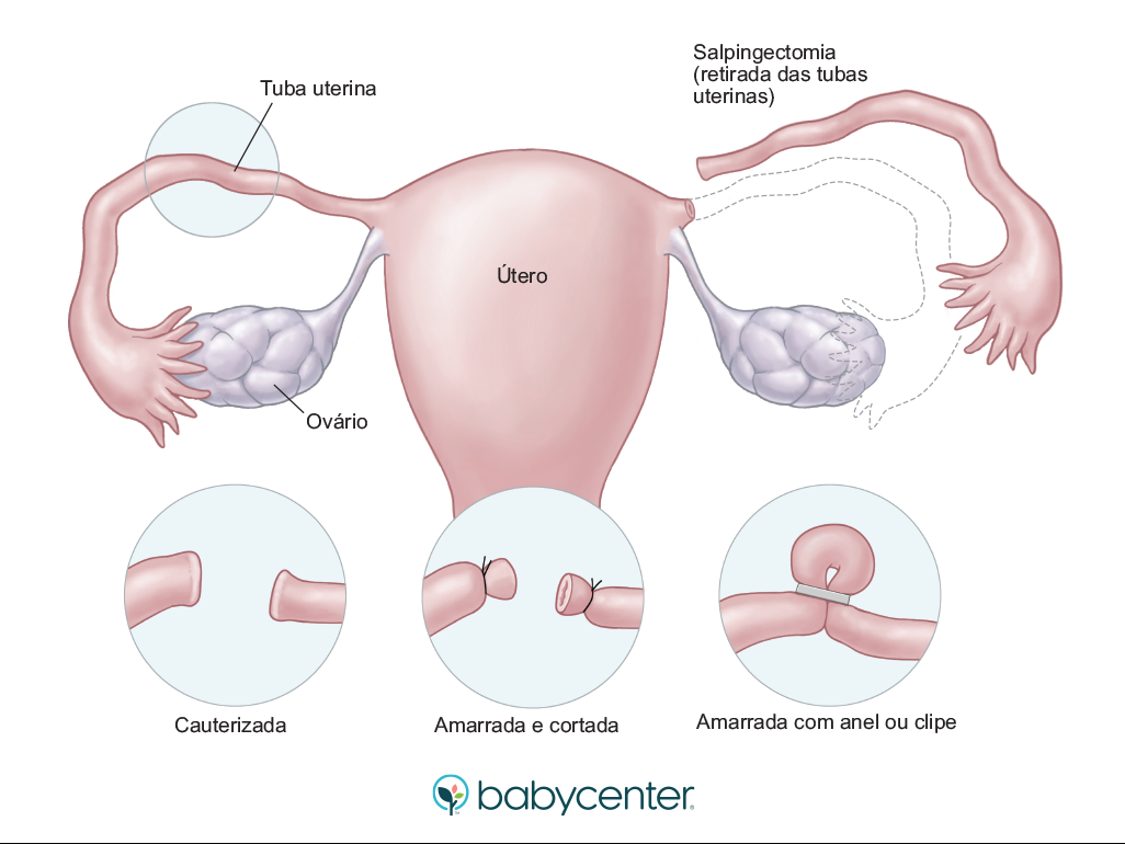 Tipos de Injeções Anticoncepcionais: Qual a Diferença? - inspiração 2