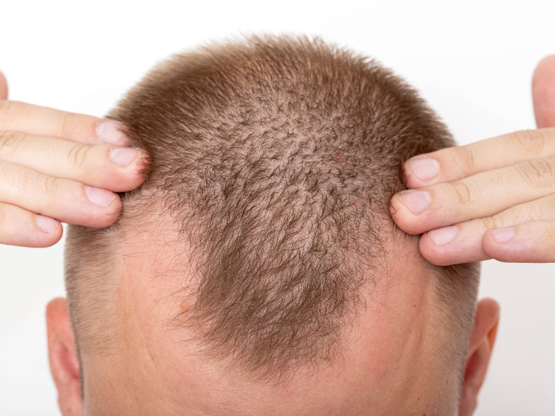 Estilo de Vida e Queda Capilar: Conexões que Você Precisa Saber - inspiração 2