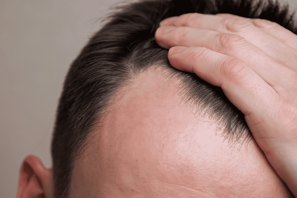 Medicamentos orais: Finasterida e sua relevância no tratamento - inspiração 1