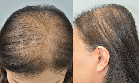 Mitos e verdades sobre a queda de cabelo por estresse e alopecia - inspiração 1