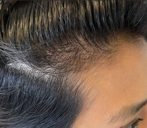 A Compreensão Profunda do Ovário Policístico e Seus Efeitos no Cabelo - inspiração 1