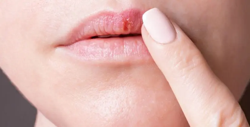 Atenção Especial Durante Surtos: Isolar e Cuidar - inspiração 2