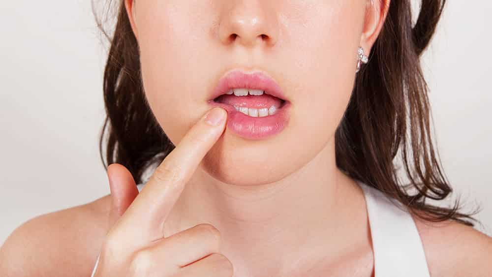 Diferenciando Lesões: Nem Toda Feridinha é Herpes Labial - inspiração 2