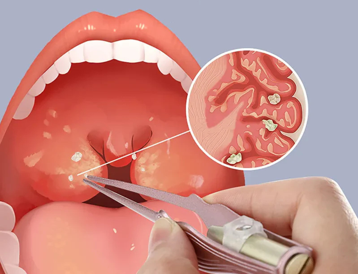 Antibióticos: um aliado com indicações precisas - inspiração 2