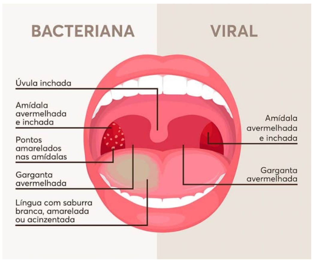 Identificando os Primeiros Sintomas da Amigdalite - inspiração 1