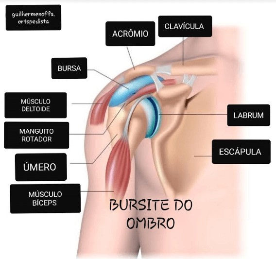Fatores Comuns que Levam à Bursite - inspiração 1