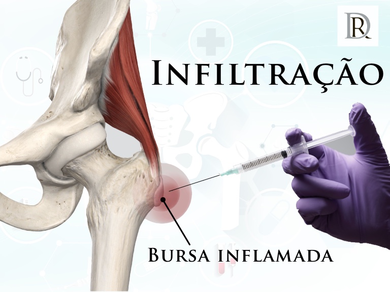 Bursite no Quadril: Identificando a Dor - inspiração 2