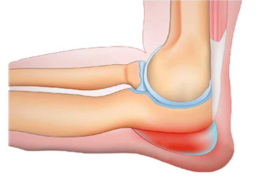 Bursite no Cotovelo: Causas e Prevenção - inspiração 1