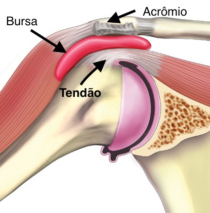 Bursite no Cotovelo: Causas e Prevenção - inspiração 2