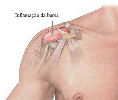 Bursite no Joelho: Impacto no Dia a Dia - inspiração 1