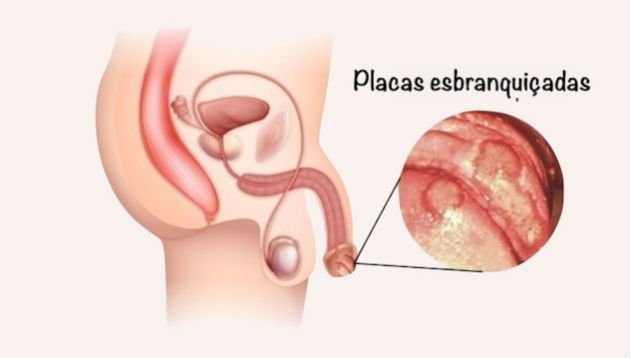 Candidíase na Gravidez: Cuidados Especiais para Mamães - inspiração 2