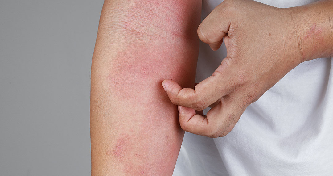 Uso de Corticoides Tópicos: Ação Anti-inflamatória Direta - inspiração 1