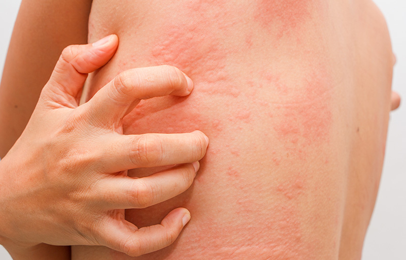 Antialérgicos Orais: Alívio Sistêmico para a Coceira Intensa - inspiração 1