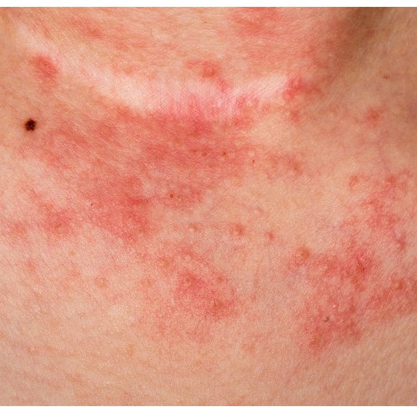 Antialérgicos Orais: Alívio Sistêmico para a Coceira Intensa - inspiração 2