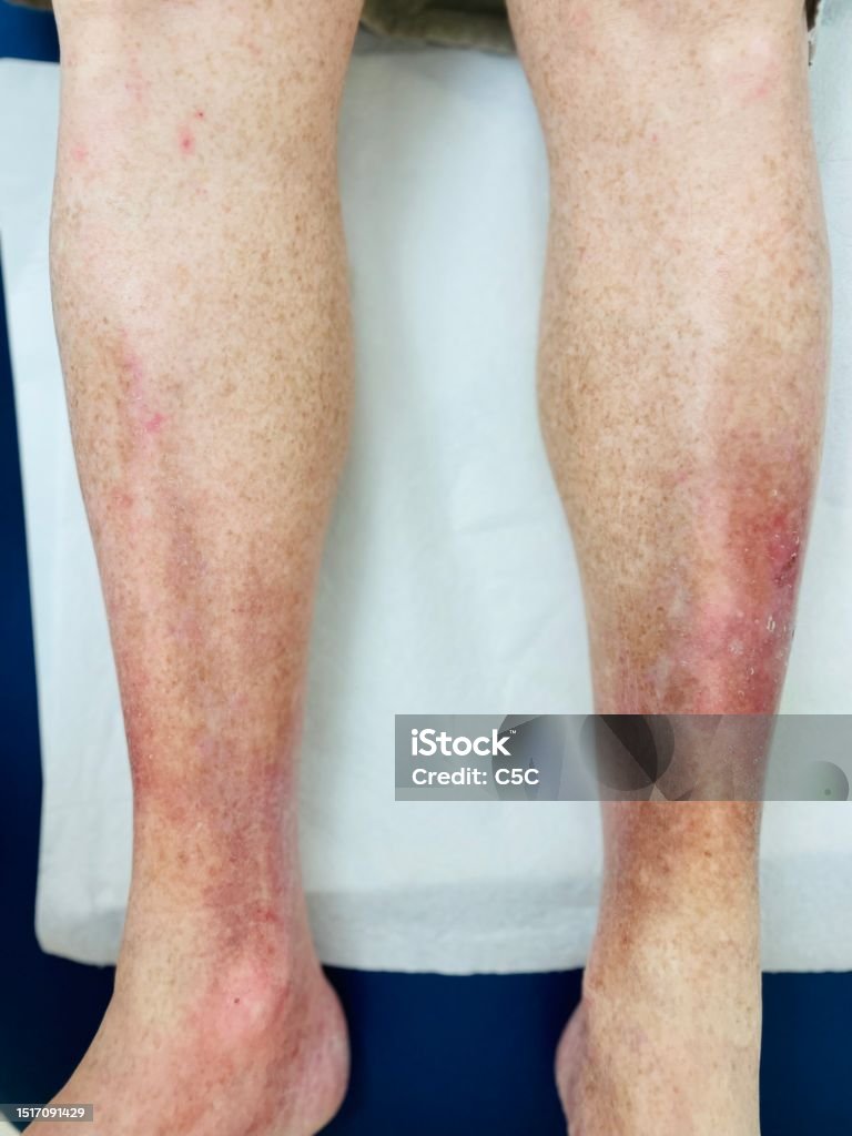 O que evitar para não agravar a condição: Calor, trauma e irritantes - inspiração 2