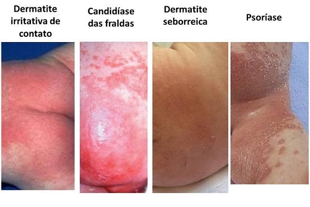 Identificando os Primeiros Sinais: O Que Procurar na Pele do Seu Bebê - inspiração 1