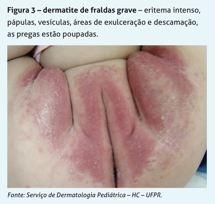 Identificando os Primeiros Sinais: O Que Procurar na Pele do Seu Bebê - inspiração 2