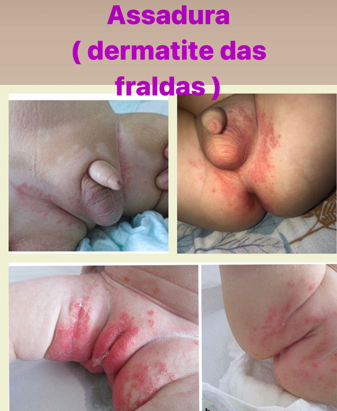 Limpeza Essencial: A Base Para Uma Pele Saudável na Área da Fralda - inspiração 2