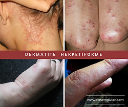 O Glúten como Principal Vilão: A Conexão com a Doença - inspiração 1