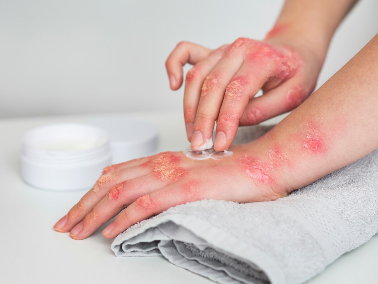 O Que Realmente é a Dermatite Herpetiforme? - inspiração 1