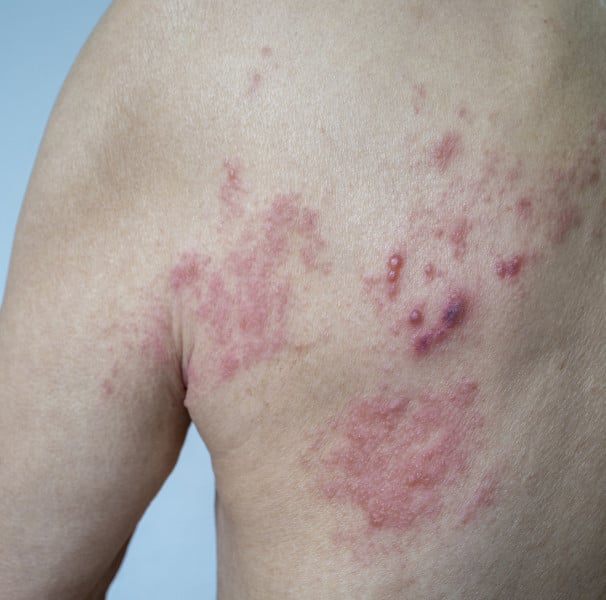 A Dieta Sem Glúten: Pilar Fundamental do Tratamento - inspiração 2