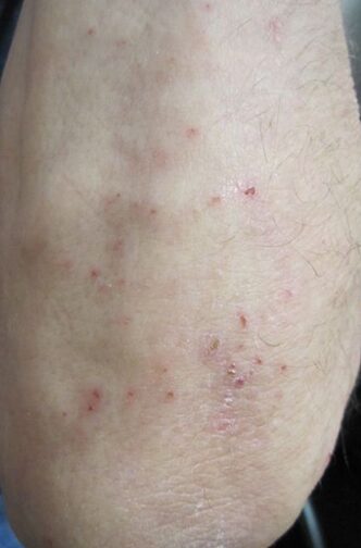 Cuidados Essenciais com a Pele Afetada - inspiração 1