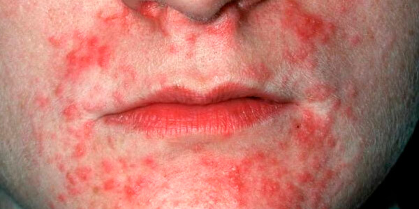 Prevenindo Recaídas e Mantendo a Saúde da Pele - inspiração 2