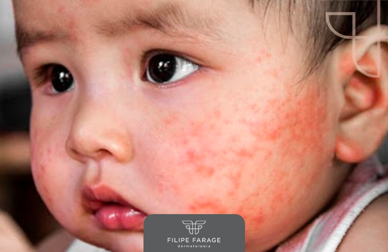 Dieta Sem Glúten: A Base do Tratamento - inspiração 1