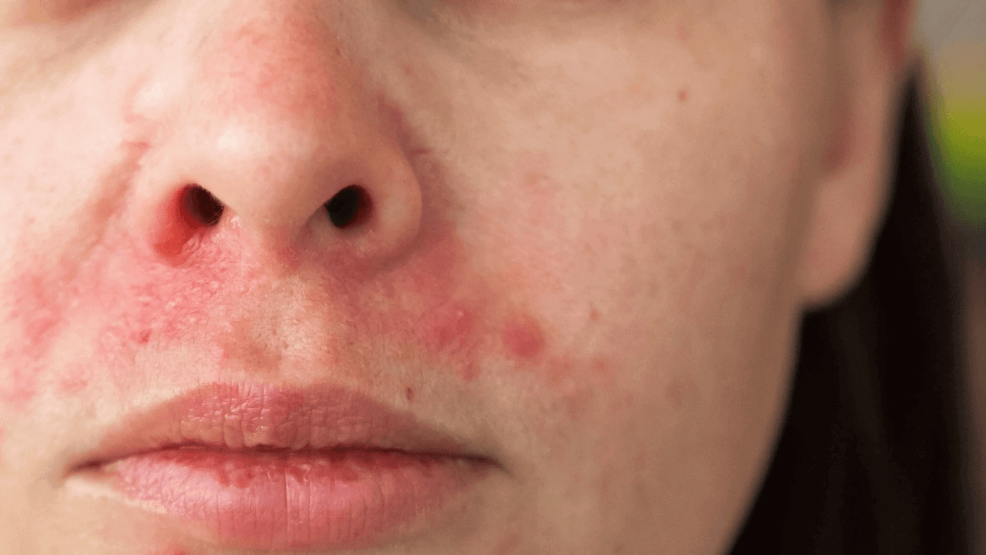 Medicamentos Tópicos e Orais: Quando Usar? - inspiração 2