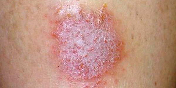 Cuidados com a Pele para Alívio Imediato - inspiração 2