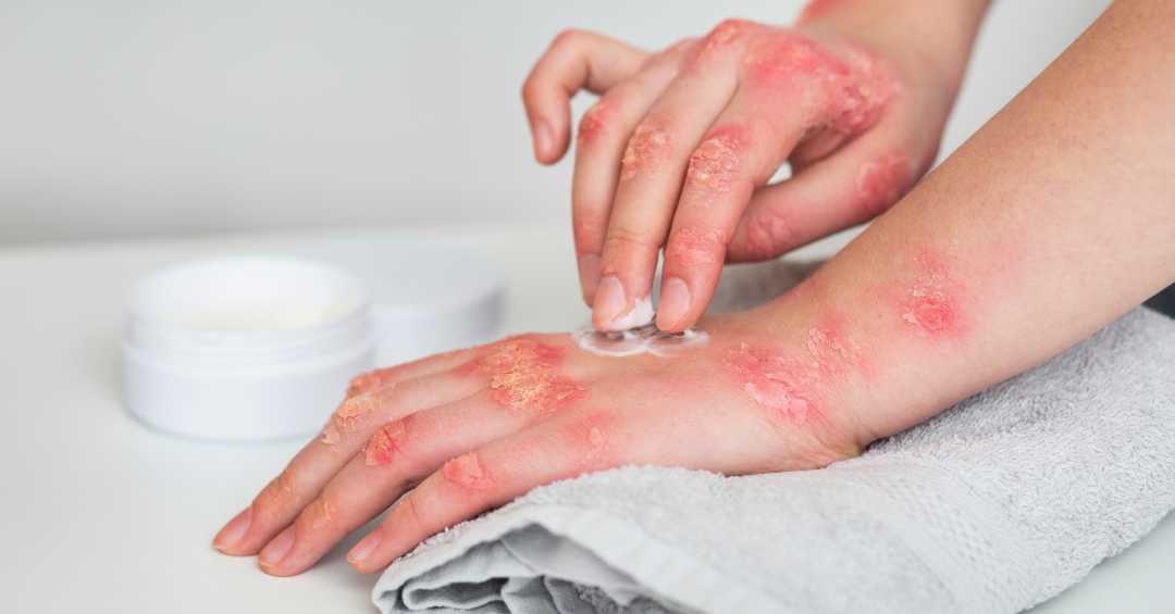 Identificando e Evitando Fontes Ocultas de Glúten - inspiração 1