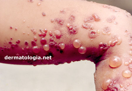 A Importância da Hidratação para a Pele Afetada - inspiração 1