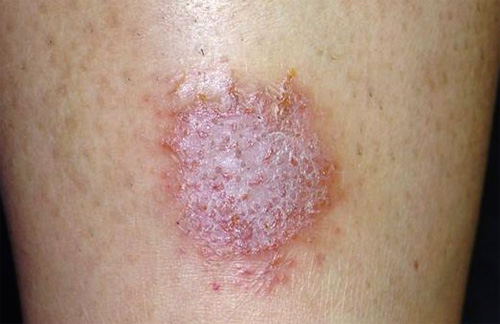 H3 Tratamentos Tópicos Prescritos: Quando e Como Usar - inspiração 2