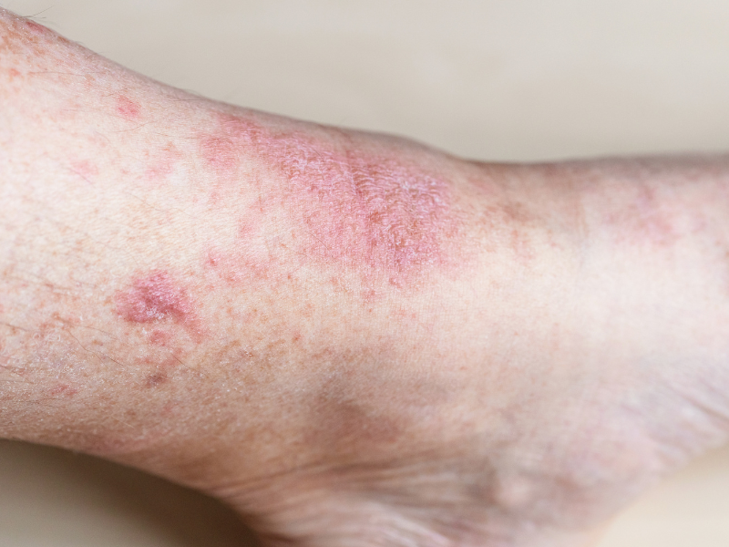 H3 A Importância da Proteção Contra Irritantes Comuns - inspiração 1