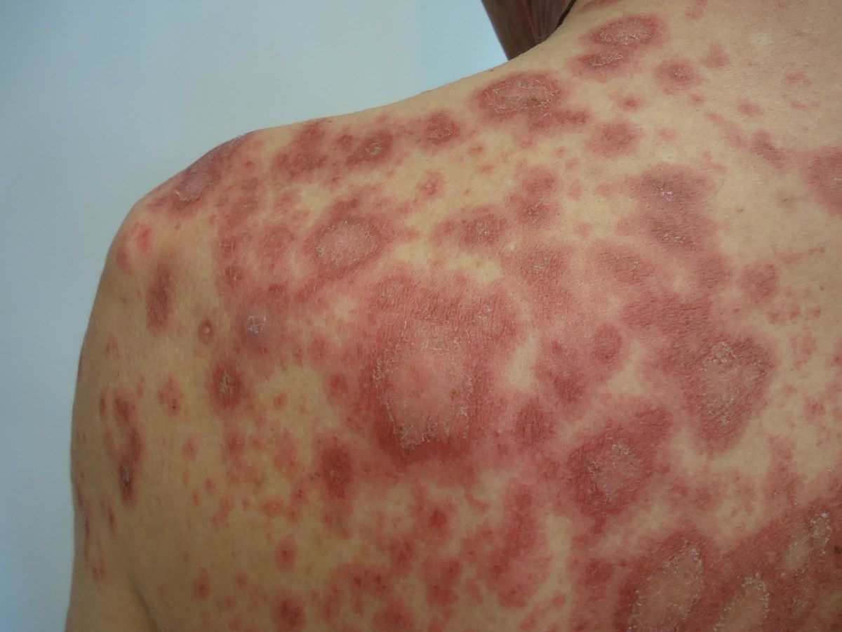 H3 Compressas Úmidas: Alívio Imediato para a Coceira Intensa - inspiração 1