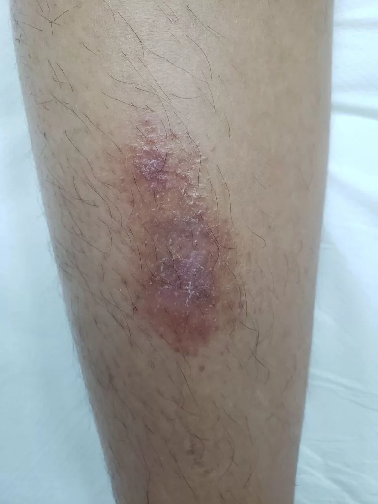 H3 O Papel dos Antialérgicos no Controle da Irritação - inspiração 1