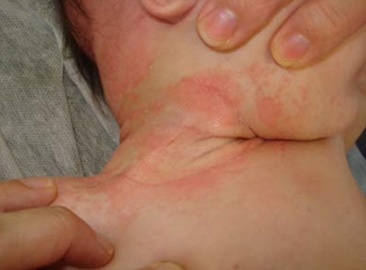 Identificando os Sinais da Dermatite Seborreica Infantil: O que observar? - inspiração 1