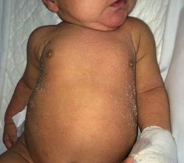 Identificando os Sinais da Dermatite Seborreica Infantil: O que observar? - inspiração 2