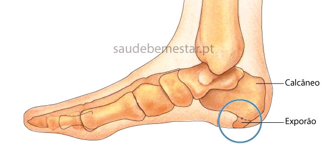 O Que é o Esporão e Por Que Ele Aparece Justamente no Seu Calcanhar? - inspiração 1