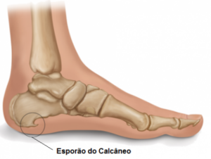 Palmilhas e Suportes: Aliados Indispensáveis para Distribuir a Pressão - inspiração 2