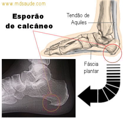 Gelo ou Calor? O Que Usar Para Reduzir a Inflamação e a Dor - inspiração 2