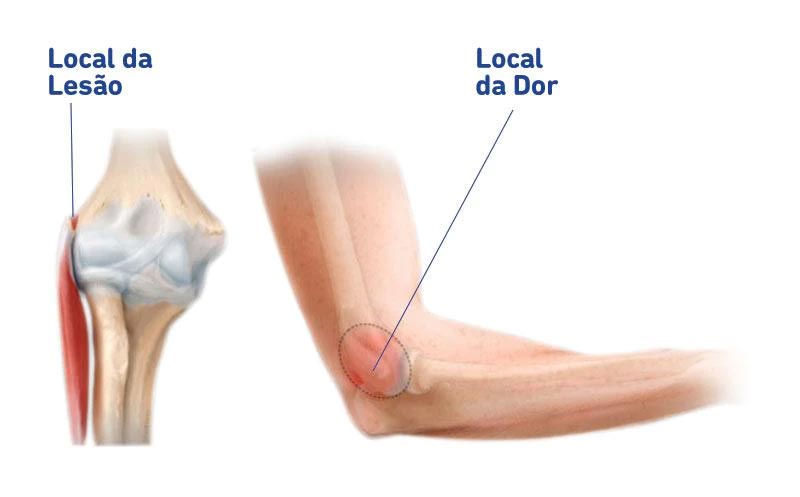 Os vilões comuns: o que causa essa dor? - inspiração 1