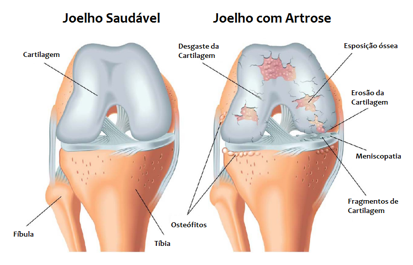 A Importância do Peso Ideal para Seus Joelhos - inspiração 2