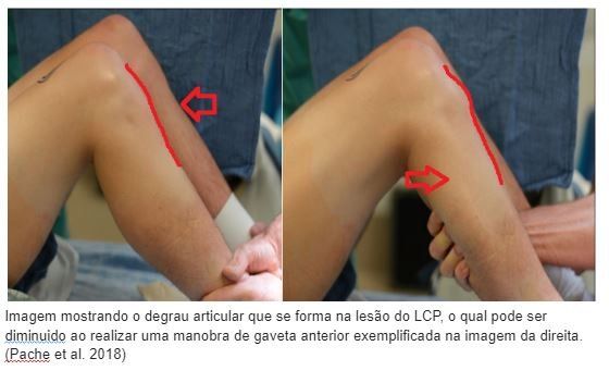 Fortalecendo os Músculos: Suporte Para Seu Joelho - inspiração 1